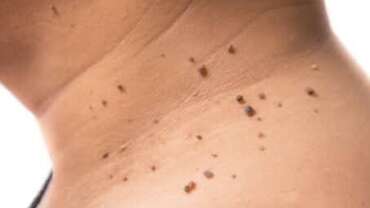Skin Tags (cutaneous papilloma)