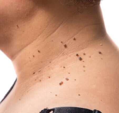 Skin Tags (cutaneous papilloma)