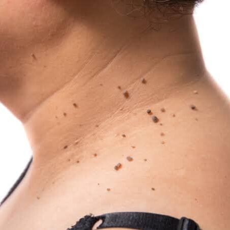 Skin Tags (cutaneous papilloma)