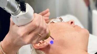 Pigmentation & Melasma with Pico Genesis