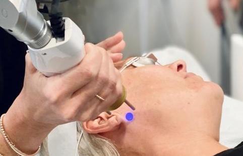 Pigmentation & Melasma with Pico Genesis