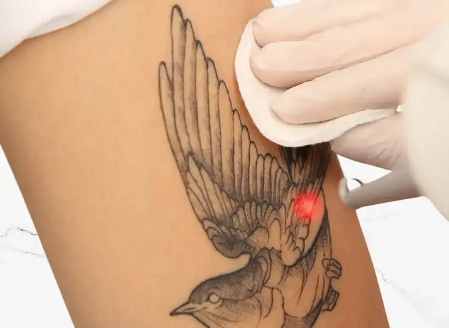 Laser Tattoo Removal