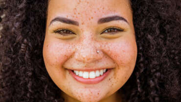 Age spots and Freckles