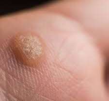 Warts and Nail fungus