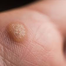 Warts and Nail fungus